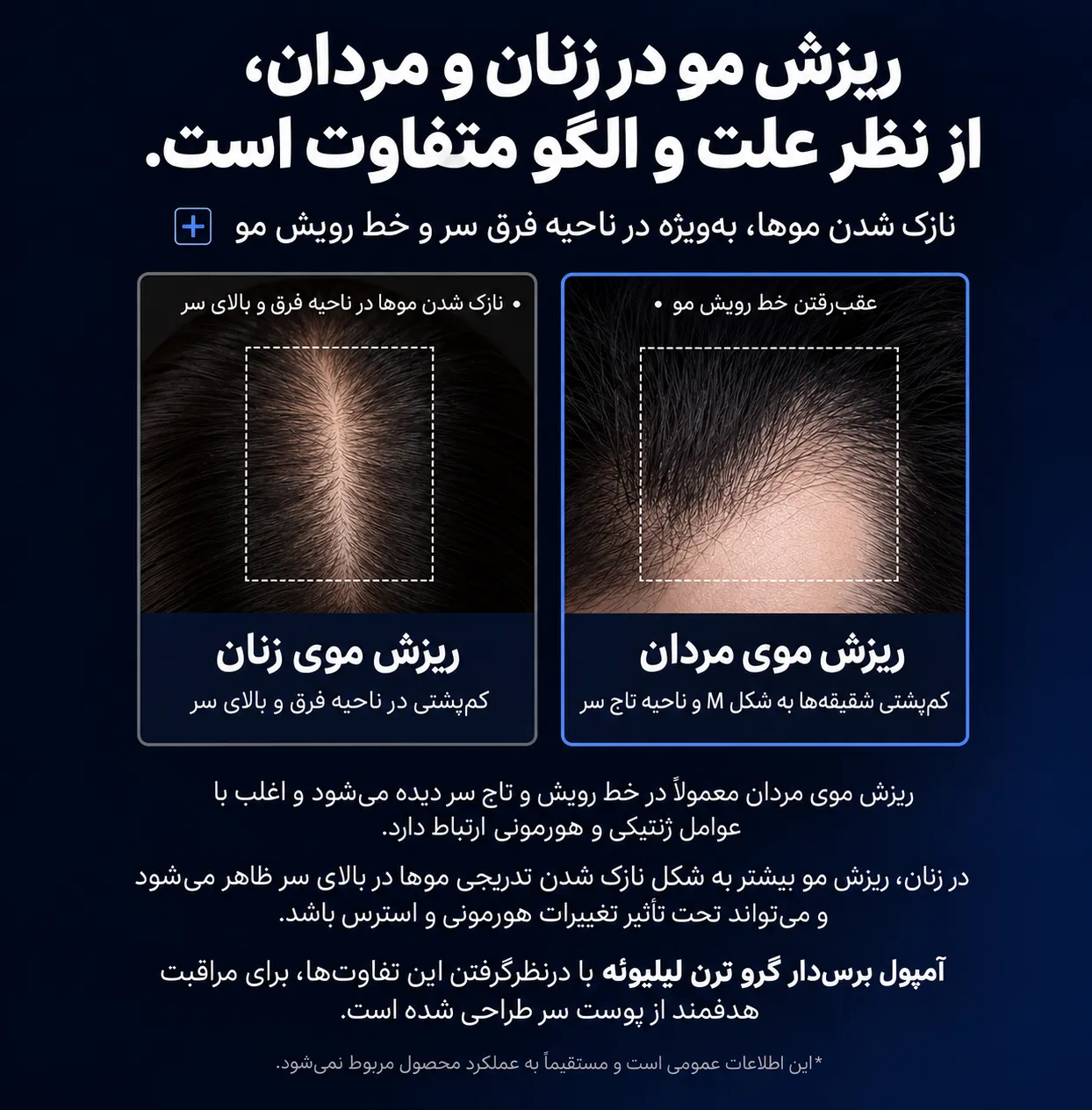 اینفوگرافیک فارسی درباره تفاوت الگوی ریزش مو در زنان و مردان و اشاره به ناحیه فرق سر و خط رویش مو